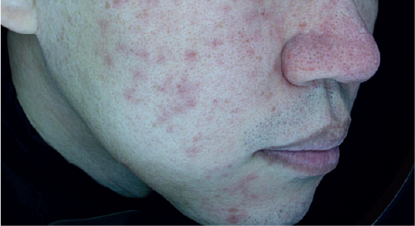 インテンスウルトラ施術後